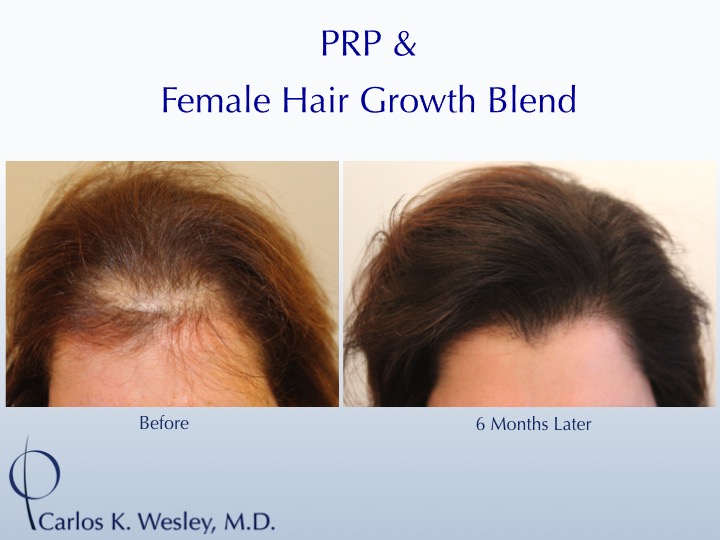 Women’s Hair Growth Blend – Carlos K. Wesley, M.D.